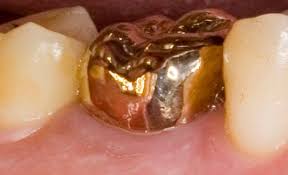 gold Dental crowns
