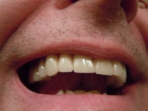 Dental crowns